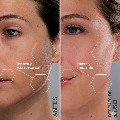 Everease Pro+ Sistema de dermaplaning sónico